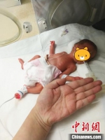 常州25周超早产“巴掌宝宝”。　钱群华　摄 - 江苏新闻网